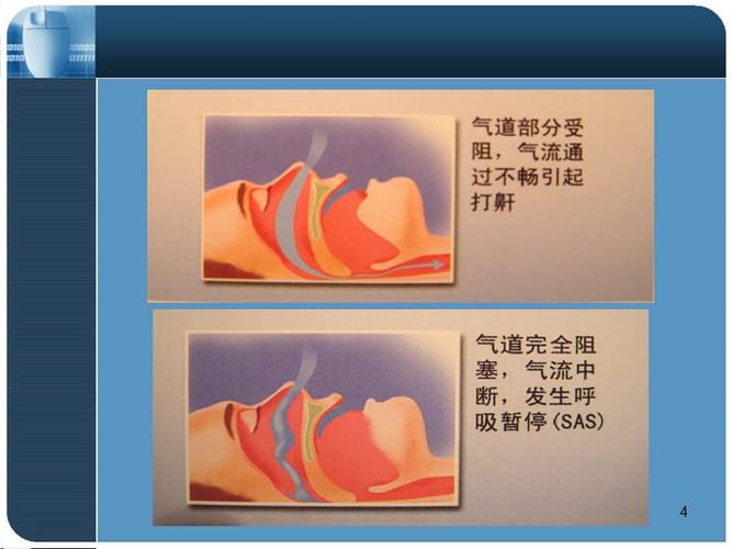阻塞性睡眠呼吸暂停低通气综合征ppt课件