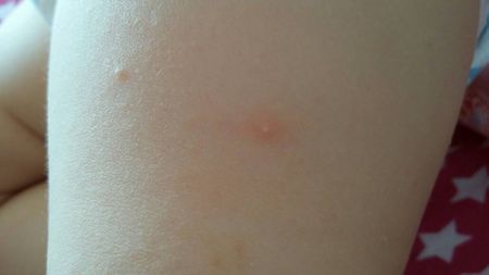 宝宝腿上的,是螨虫咬的吗