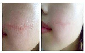 划伤的手术疤痕缝针疤痕怎样去除呢?