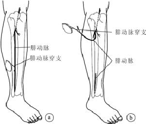 腓动脉及穿支血管蒂皮瓣移位修复