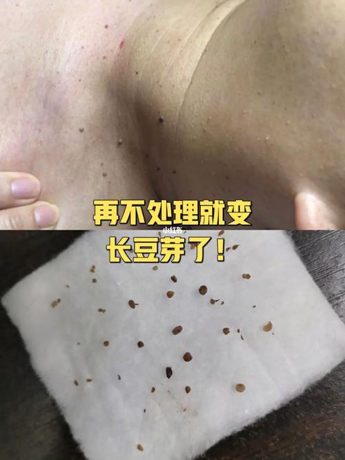 脖子突然就长出了小肉芽_美业_手艺人