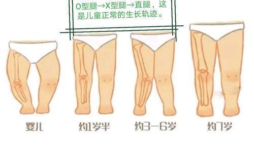 不慌,这些阶段腿型"不正常"