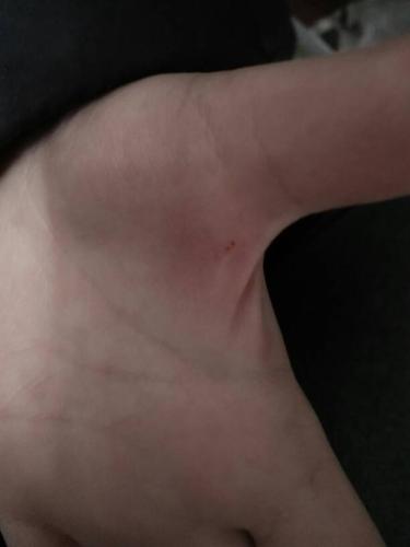 被仓鼠咬了会怎样?