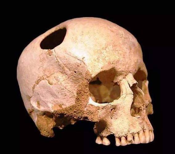 原创如果华佗劈开曹操头颅真能治好他的头疼吗考古发现给出新证据