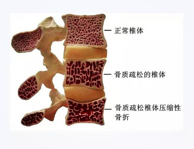 脊柱骨专家提醒您:老年人胸腰椎骨折,切不可静养丨这种技术可不开刀