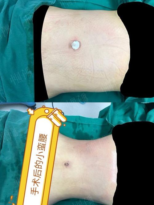 威塑腰腹环吸,没必要找什么借口,胖就是瘦的理由.