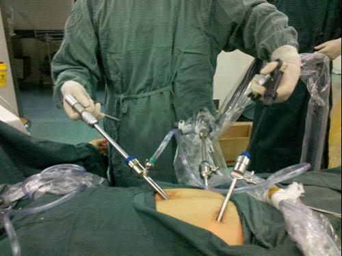 腹腔镜阑尾切除术阑尾残端处理的方式比较