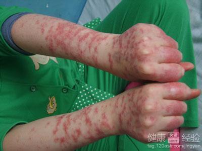 皮肤红斑狼疮图片