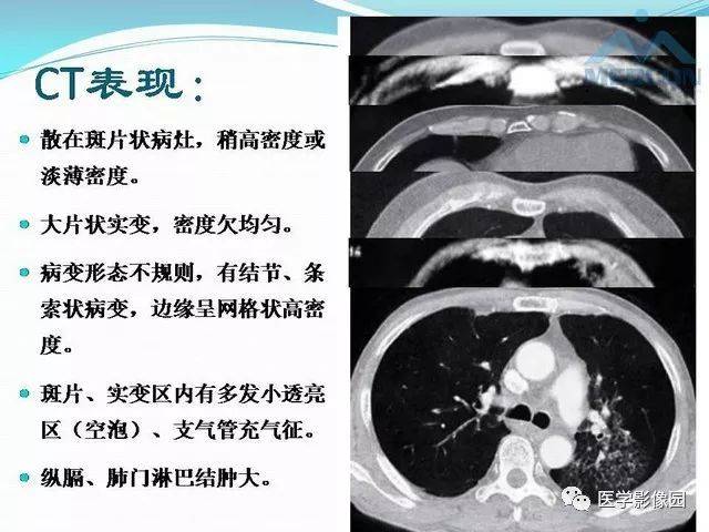 "肺炎型"肺癌的ct表现及病理学基础 | 影像天地