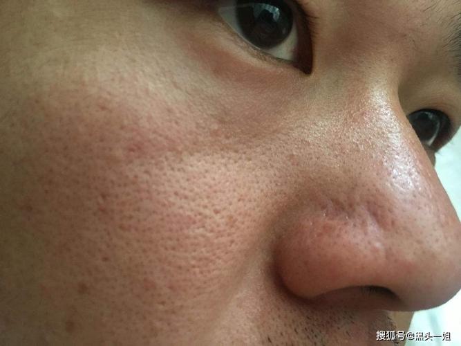 面部角质层厚,用什么护肤品去角质比较好?_皮肤