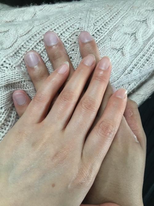 男,23岁,10个手指甲颜色发灰紫,手温正常,请问是什么原因?需要治疗吗?