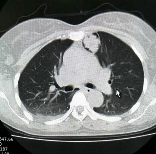 左肺上叶错构瘤