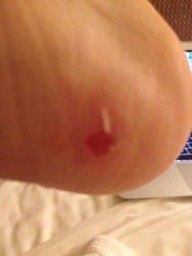 脚后跟被新买的鞋子磨破了 超级痛 皮都掉了 咋办啊?