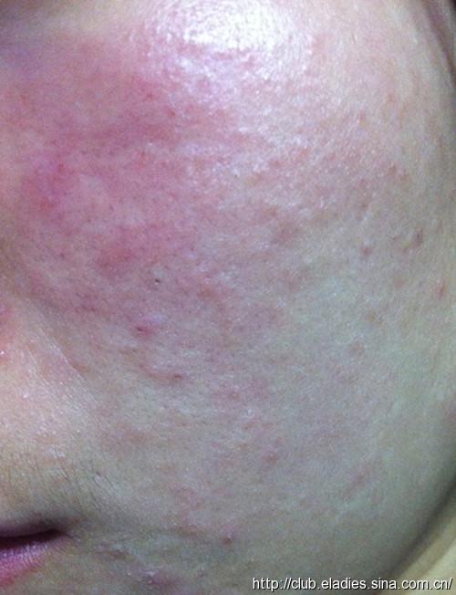 脸总过敏怎么办_脸上过敏怎么办谁有妙招