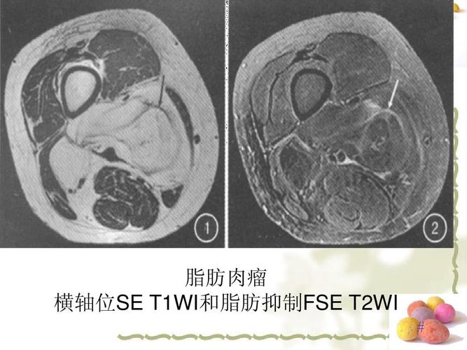 这是我参加班级讲课比赛所用的,呕心沥血o(∩_∩)o~ 脂肪肉瘤 横轴位