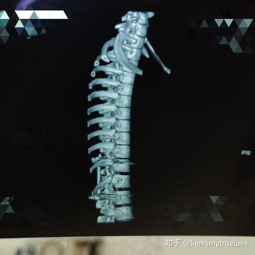 胸椎压缩性骨折是怎样的体验