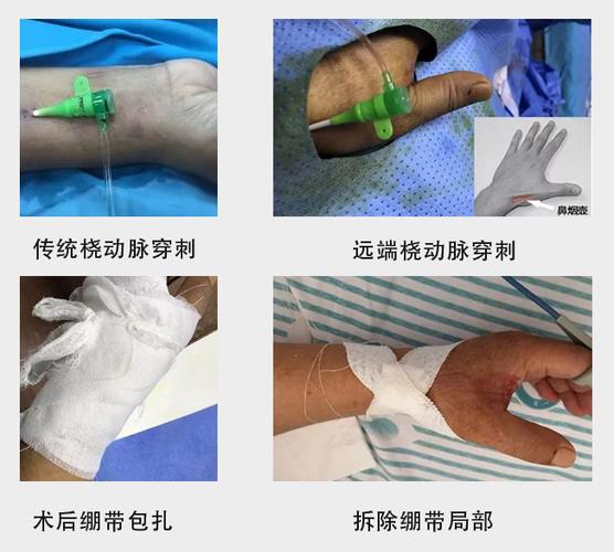 远端桡动脉入路冠脉介入治疗是什么