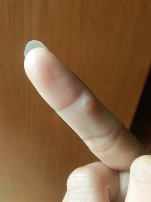 手上,长了一个类似鱼鳞痣鸡眼一样的肉疙瘩,不知道是什么,硬硬的,很痛