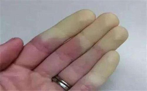 手掌出现这样的特征早期糖尿病