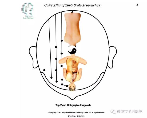 喜迎夏至即来,脑科医院康复科针灸治疗开展的"朱氏"脑