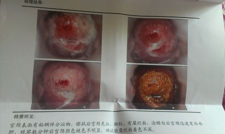 刚做完人流,检查出有宫颈糜烂,帮看看严重吗?