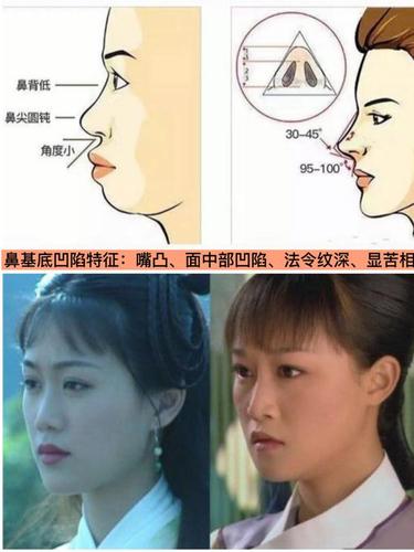 侧脸太虐快来测测是不是鼻基底凹陷