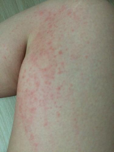 大腿内侧突然过敏,起小红包,多天不下,请问是什么原因