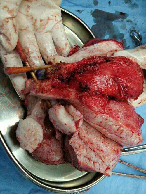 双子宫合并子宫腺肌症行全宫切除术一例