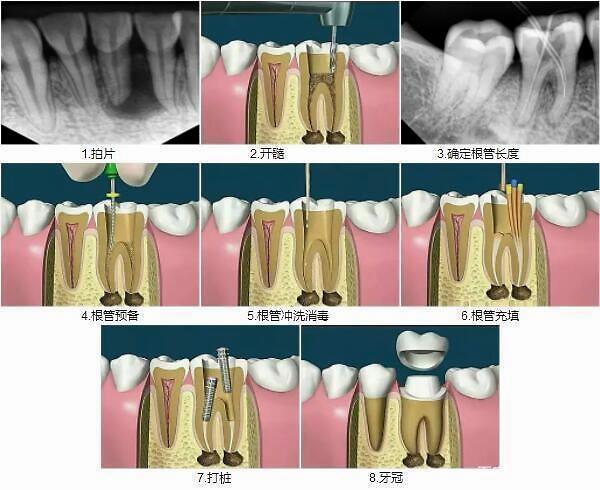 根管治疗后的牙齿还能用多久