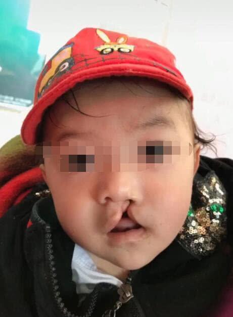 兔唇宝宝的怎么形成的?跟父母的不当行为有关