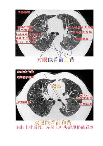 ct肺的分叶分段