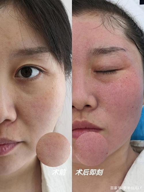 抗衰微针效果图大分享!