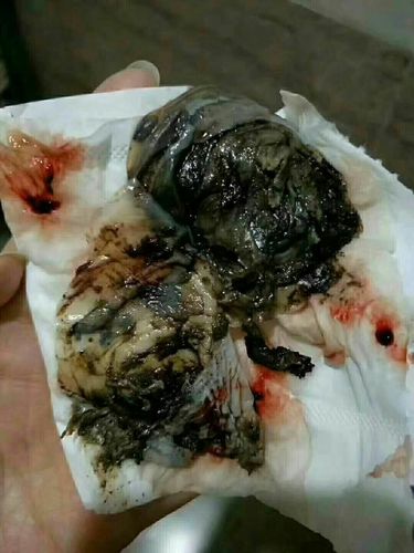 喜报——又排出 子宫肌瘤