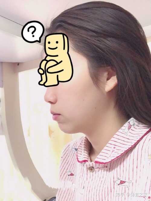 牙套3个月2017.12