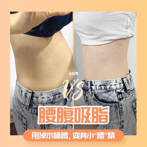 腰腹吸脂真实对比_腰腹_吸脂_易瘦体质_腰腹环吸_减肥