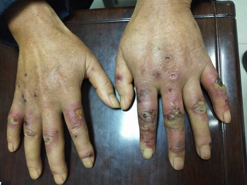 "好男人"寒冬做家务坚持冷水洗衣洗菜,患上升级版冻疮双手溃烂