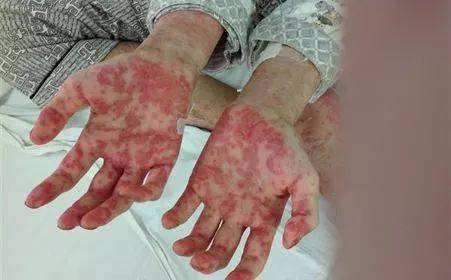 疾病| 小儿白血病早期三大症状千万别忽视手机搜狐网