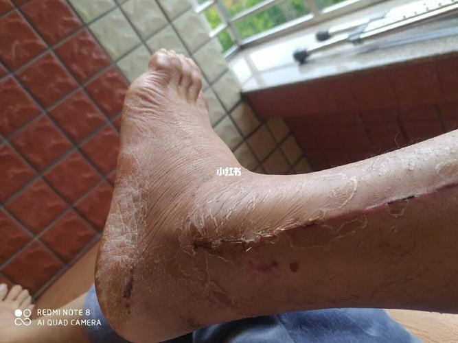 小腿骨折_运动_骨折康复_医疗健康_医疗健康其他