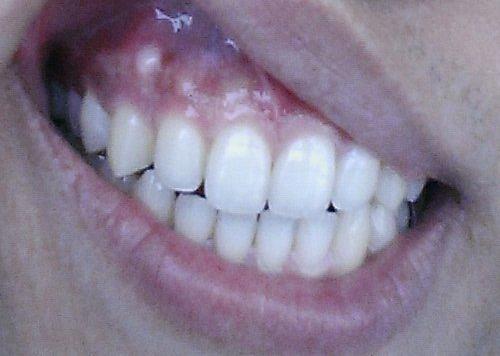 问:牙龈有一颗硬质的白色凸起,不疼不痒,要紧么?