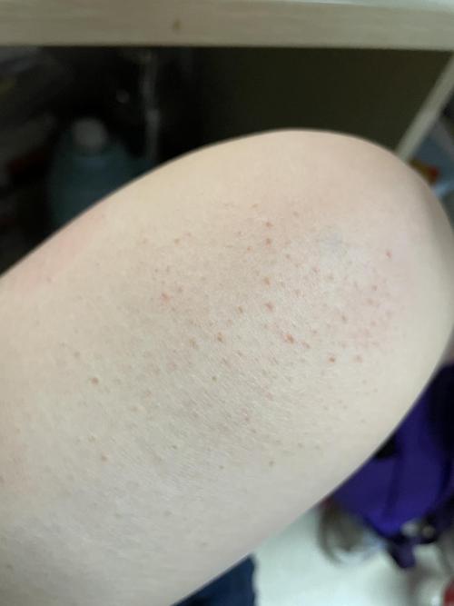 请问腿上长小疙瘩是什么呢