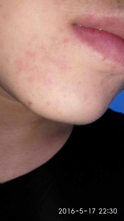 嘴下面长了密密麻麻的小水泡,两天淡了两天又起来了,连续好几个月了刚