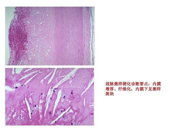 内膜 增厚,纤维化; 增厚,纤维化;内膜下见粥样 斑块