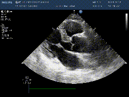 如何分辨三尖瓣的三个瓣叶?