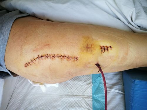 术后2天伤口换药情况