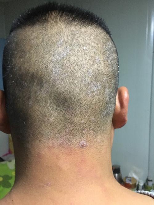 百度我这种头皮癣是什么癣 不痒