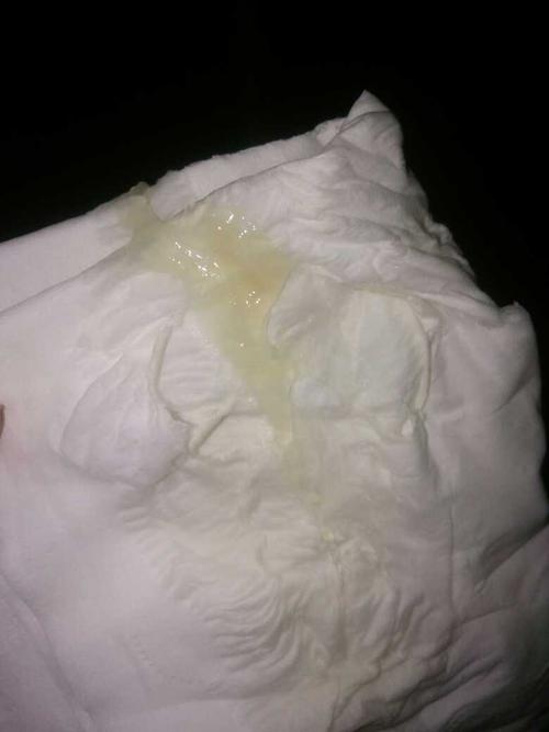 【临产症状】宫颈粘液 《有图慎入》