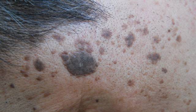 惊呆了,身上长黑痣,白斑,血痣竟然意味着