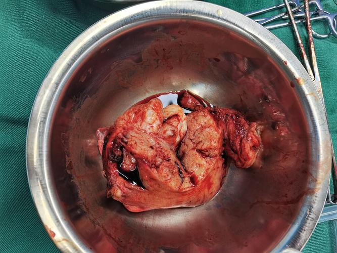 万载县人民医院西院成功开展腹腔镜下子宫全切术 双侧输卵管切除术