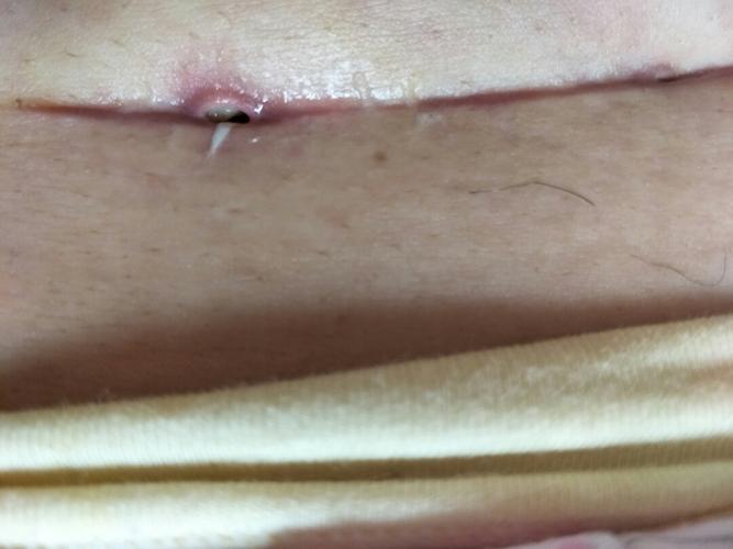 剖腹产25天了,但是伤口有俩个小洞,还有白色线头,该怎么办?