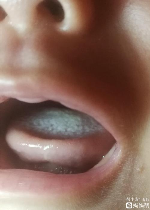 三月龄男宝宝,舌头白色的是鹅口疮还是奶垢